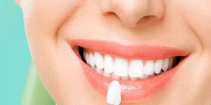 composite veneer lifespan