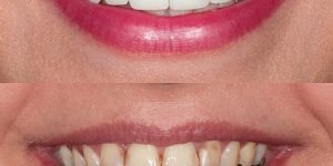 Types of Cosmetic Dentistry Procedures