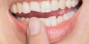 a photo of lady pointing to a cracked tooth
