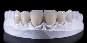 All you should know about dental crown glue