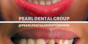 dental bonding and veneer