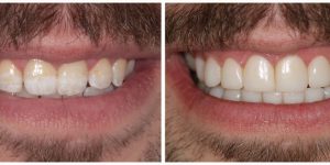 Improve Your Smile with Composite Veneers