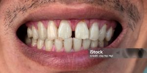 gaps between teeth