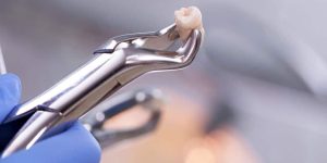 signs you need wisdom tooth extraction