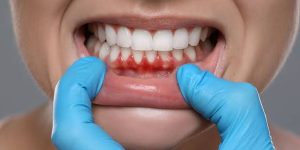 a photo showing tooth abscess stage 1