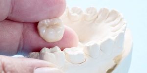 What Are the Alternatives for a Dental Crown?